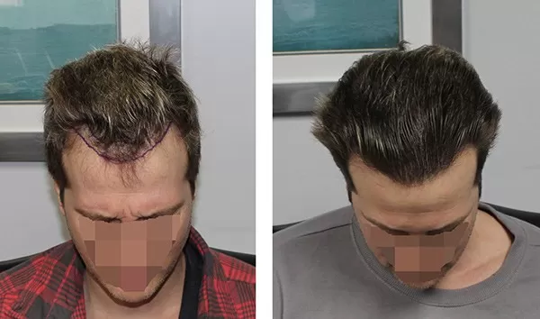 best hair transplant in delhi, FUE hair transplant in delhi