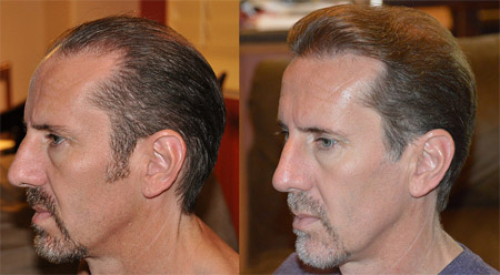 best hair transplant clinic in delhi